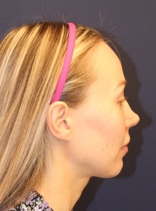 Peels Before & After Gallery - Patient 232957 - Image 6