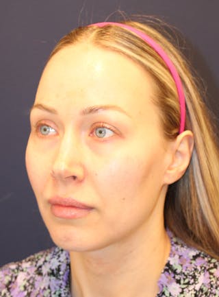 Peels Before & After Gallery - Patient 232957 - Image 8