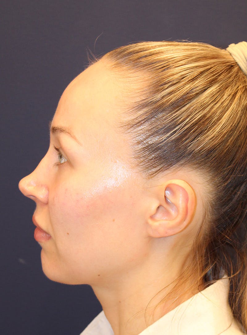 Peels Before & After Gallery - Patient 232957 - Image 9
