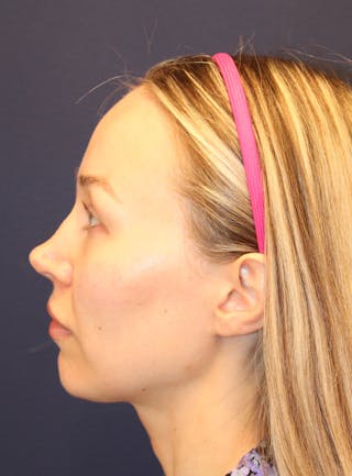 Peels Before & After Gallery - Patient 232957 - Image 10