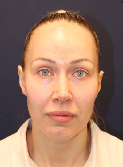 Peels Before & After Gallery - Patient 232957 - Image 1