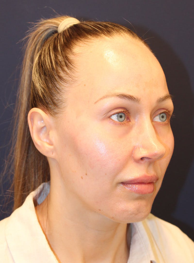 Peels Before & After Gallery - Patient 232957 - Image 3