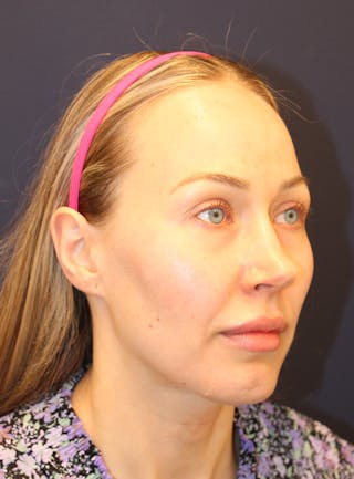 Peels Before & After Gallery - Patient 232957 - Image 4