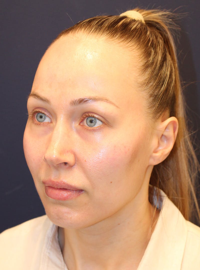 Peels Before & After Gallery - Patient 232957 - Image 7
