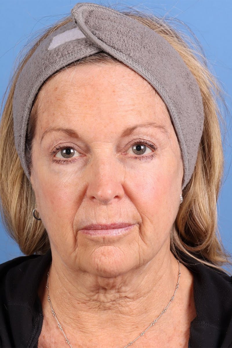 Sofwave Before & After Gallery - Patient 313903 - Image 1
