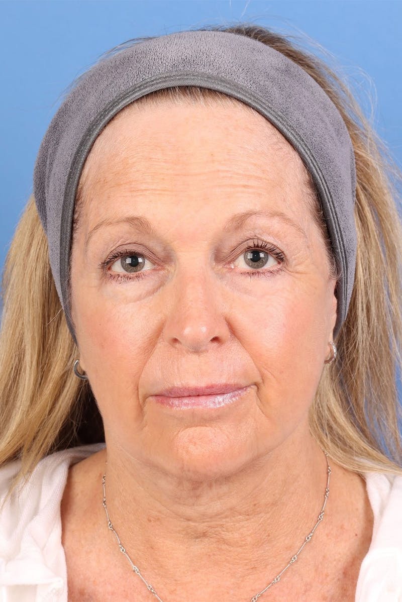 Sofwave Before & After Gallery - Patient 313903 - Image 2