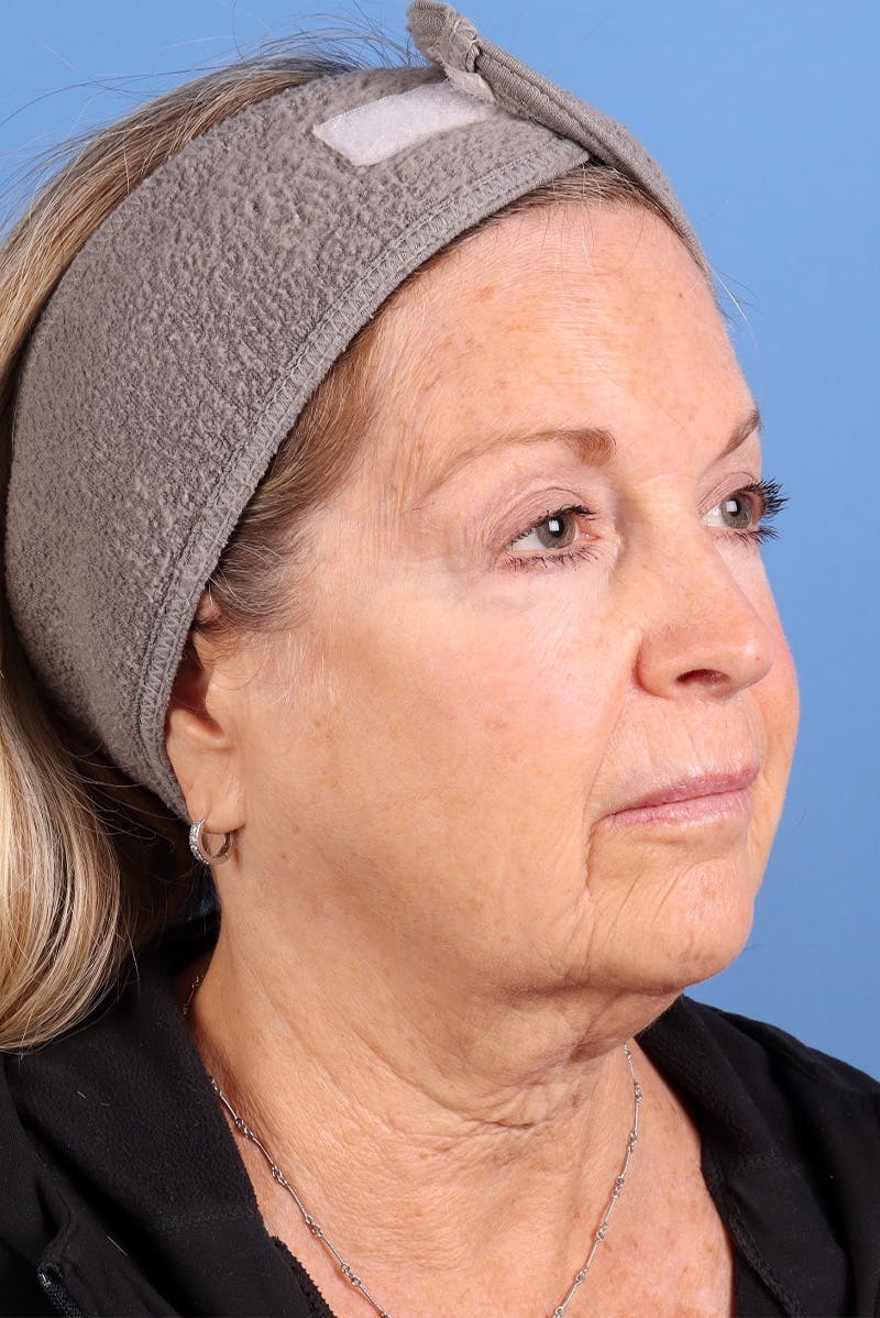 Sofwave Before & After Gallery - Patient 313903 - Image 3