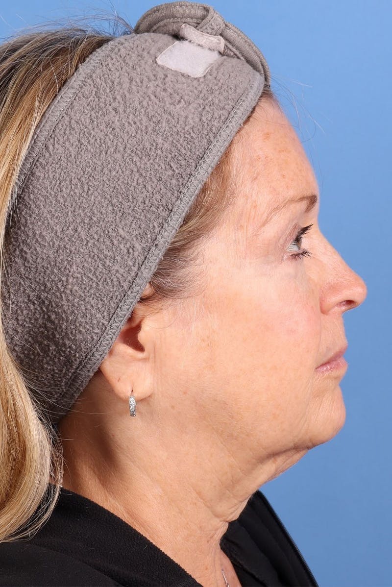 Sofwave Before & After Gallery - Patient 313903 - Image 5
