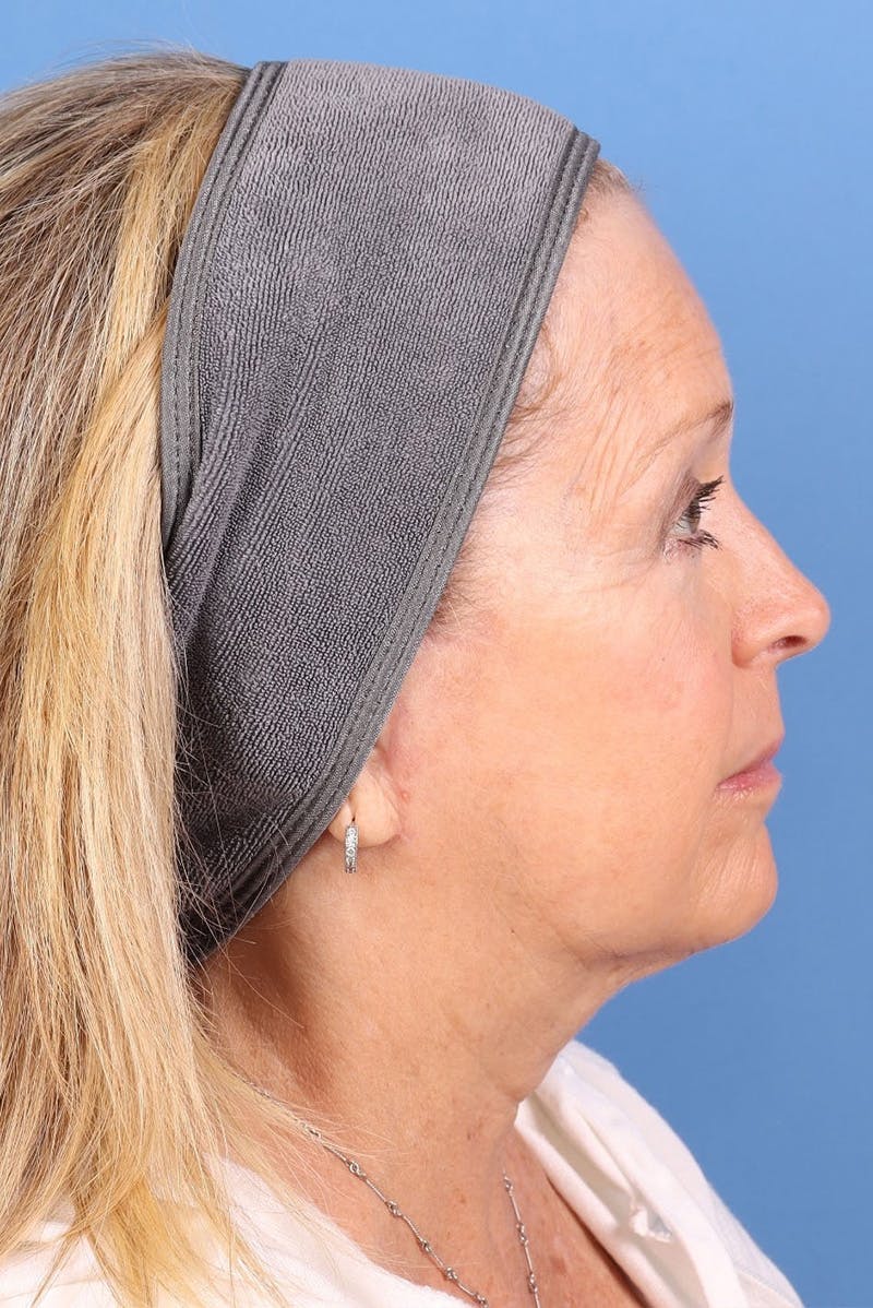 Sofwave Before & After Gallery - Patient 313903 - Image 6