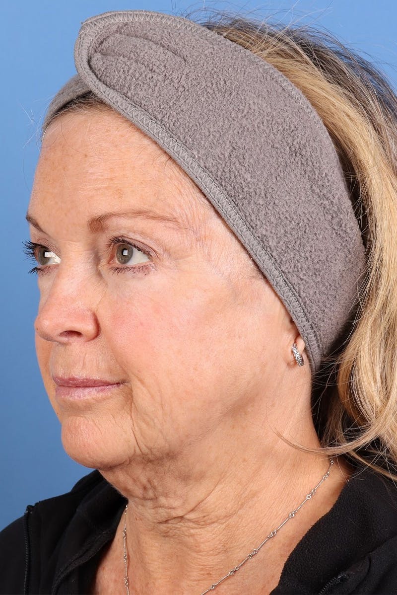 Sofwave Before & After Gallery - Patient 313903 - Image 7