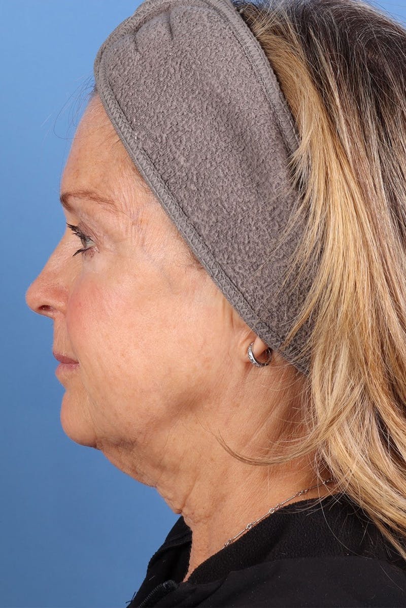 Sofwave Before & After Gallery - Patient 313903 - Image 9
