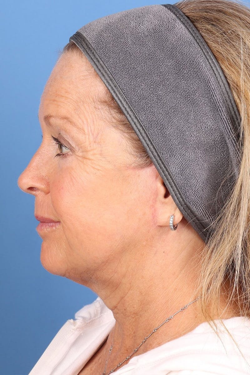 Sofwave Before & After Gallery - Patient 313903 - Image 10