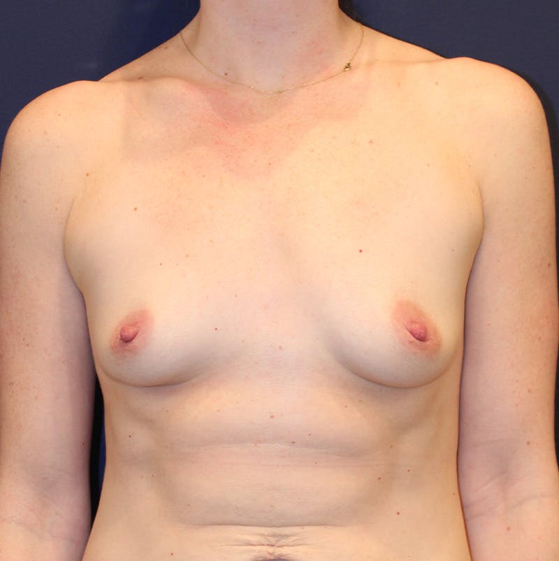 Breast Augmentation Before & After Gallery - Patient 367850 - Image 1