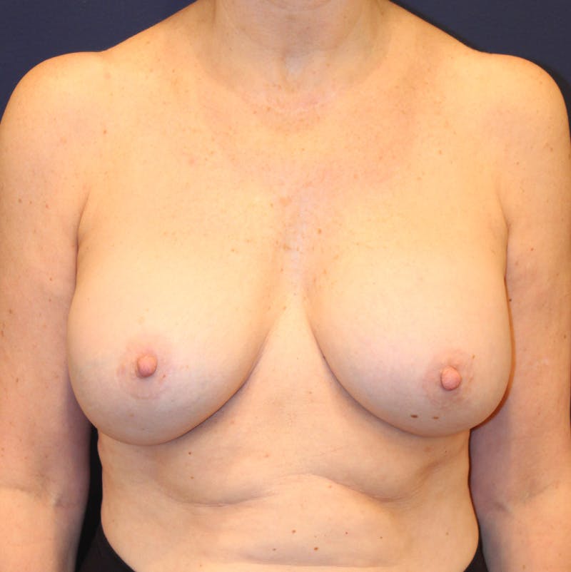 Breast Implant Revision Before & After Gallery - Patient 393108 - Image 2