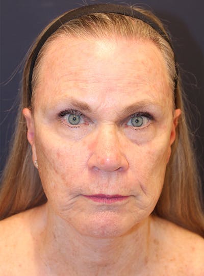Peels Before & After Gallery - Patient 141952 - Image 1