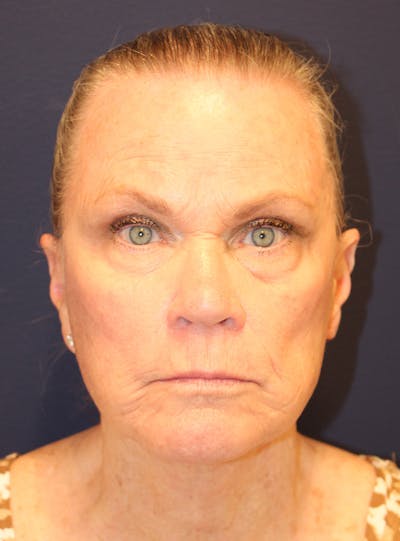 Peels Before & After Gallery - Patient 141952 - Image 2