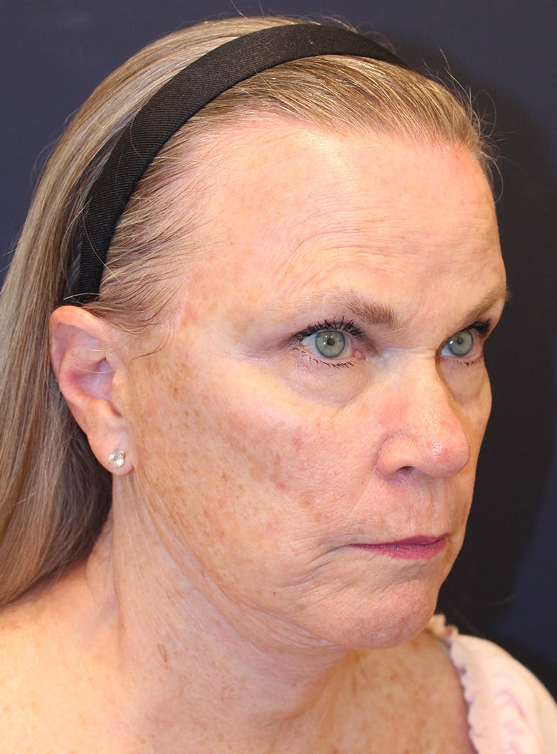 Peels Before & After Gallery - Patient 141952 - Image 3