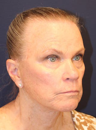 Peels Before & After Gallery - Patient 141952 - Image 4