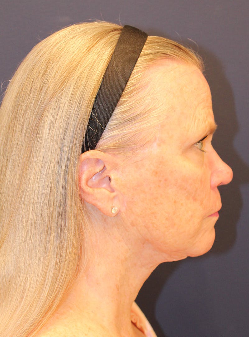 Peels Before & After Gallery - Patient 141952 - Image 5