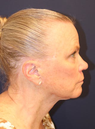 Peels Before & After Gallery - Patient 141952 - Image 6