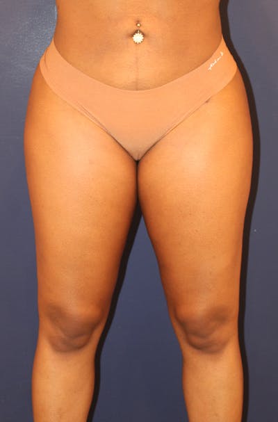 Liposuction Before & After Gallery - Patient 332640 - Image 2