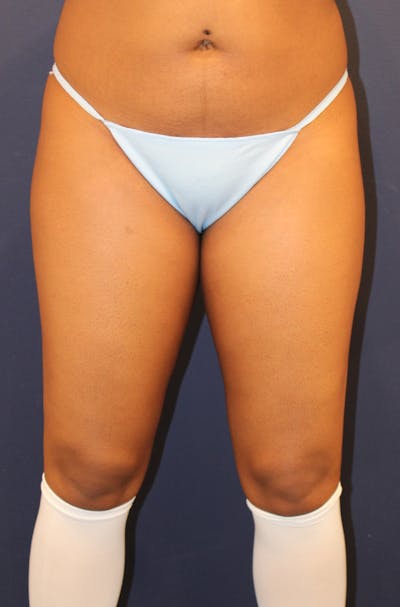 Liposuction Before & After Gallery - Patient 332640 - Image 1