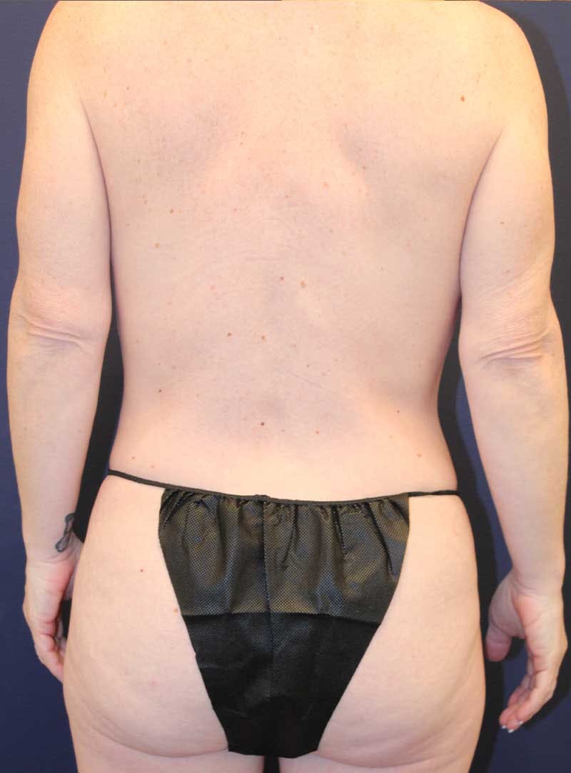 Mommy Makeover Before & After Gallery - Patient 198722 - Image 7