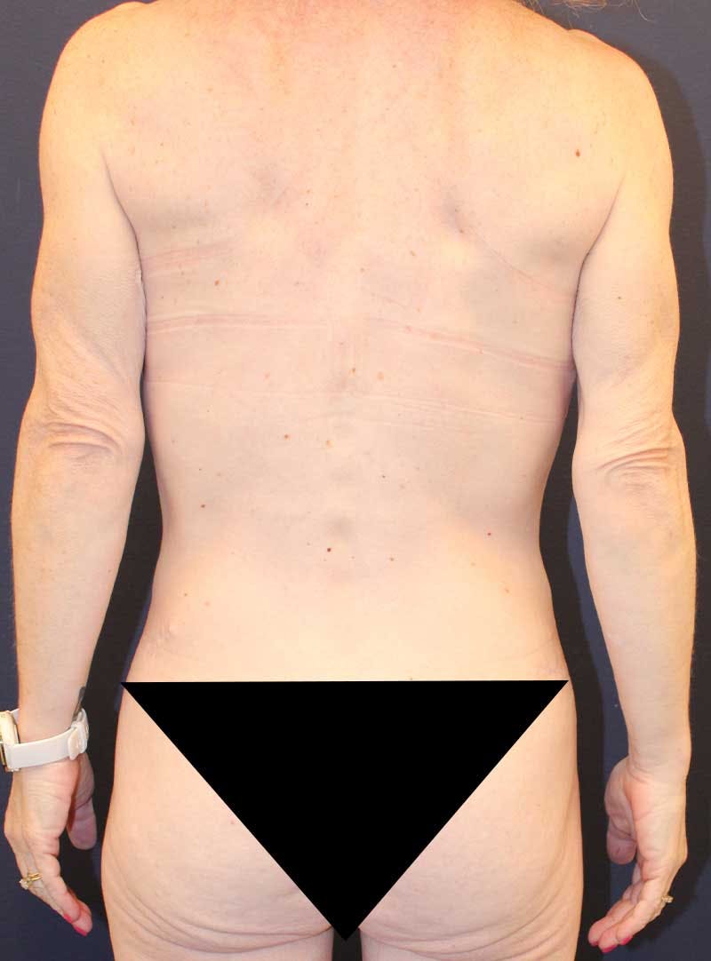 Mommy Makeover Before & After Gallery - Patient 198722 - Image 8