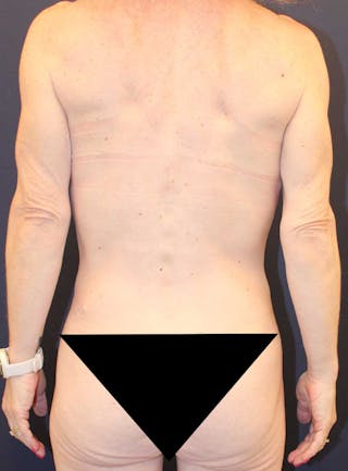 Mommy Makeover Before & After Gallery - Patient 198722 - Image 8