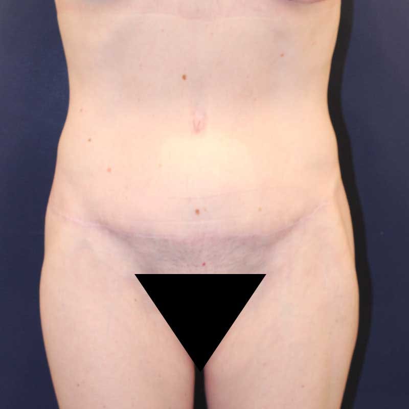 Tummy Tuck Before & After Gallery - Patient 160633 - Image 2