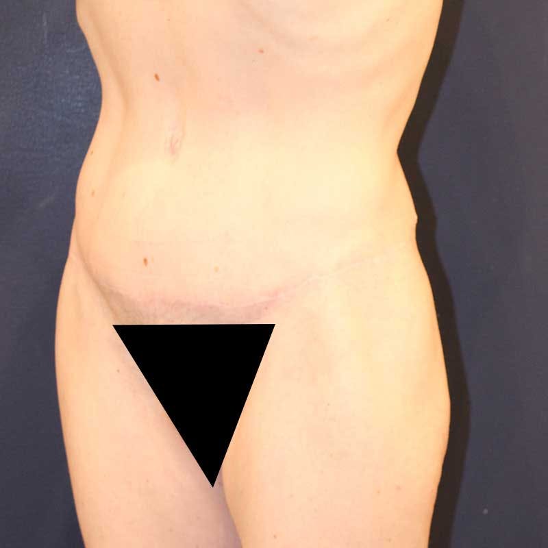 Tummy Tuck Before & After Gallery - Patient 160633 - Image 4