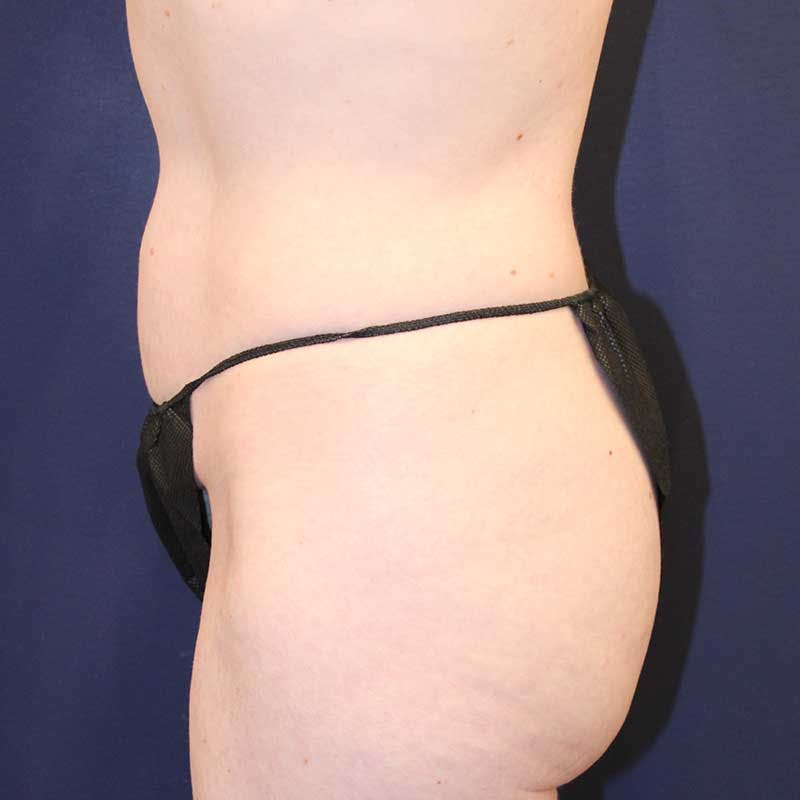 Tummy Tuck Before & After Gallery - Patient 160633 - Image 5