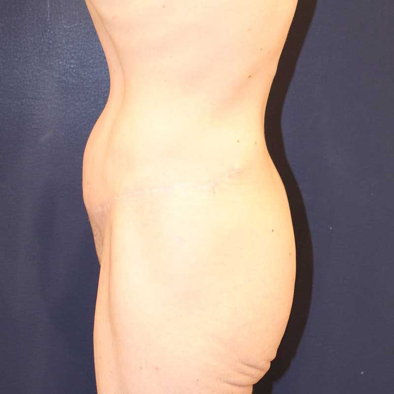 Tummy Tuck Before & After Gallery - Patient 160633 - Image 6