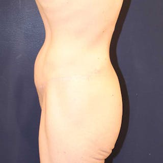 Tummy Tuck Before & After Gallery - Patient 160633 - Image 6