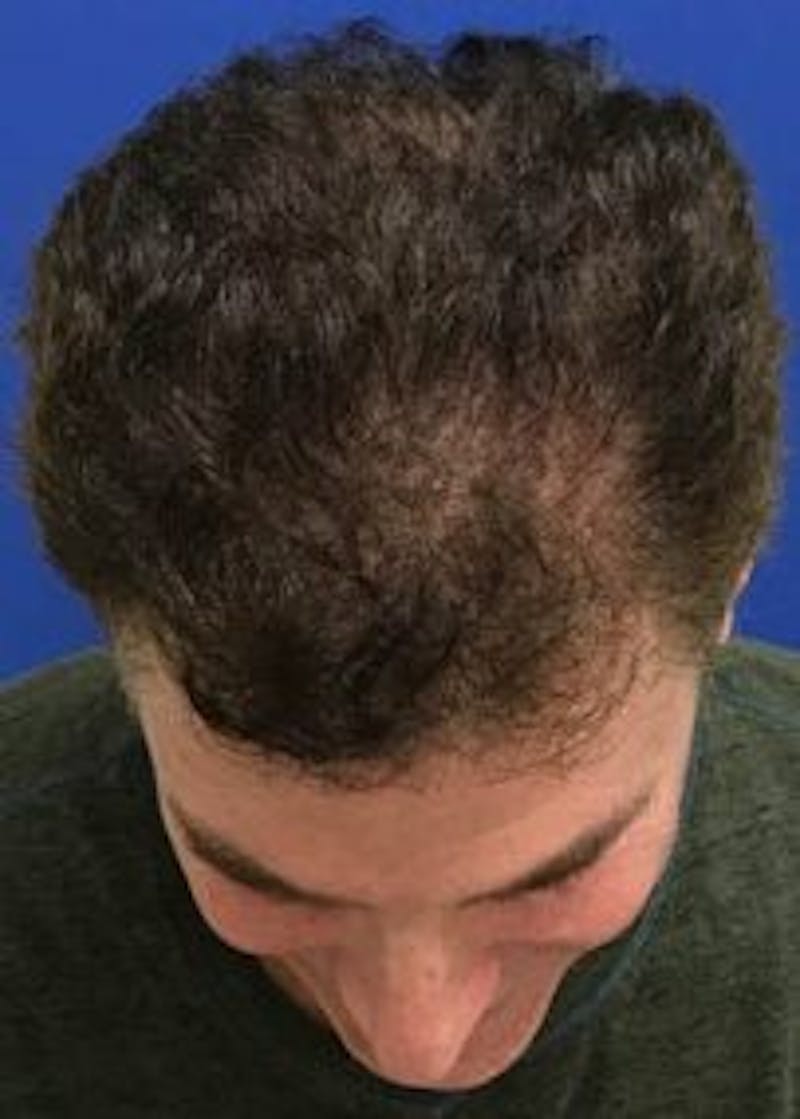 Male Surgical Gallery Before & After Gallery - Patient 166658294 - Image 1