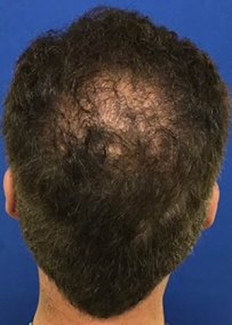Male Surgical Gallery Before & After Gallery - Patient 166658294 - Image 3