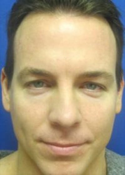 Male Surgical Gallery Before & After Gallery - Patient 166658336 - Image 1