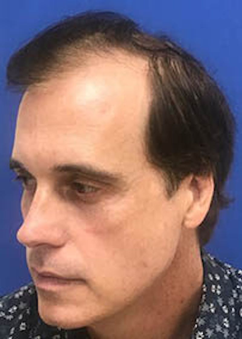 Male Surgical Gallery Before & After Gallery - Patient 166658355 - Image 3