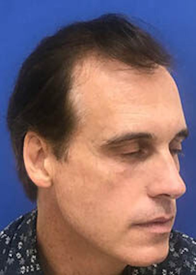 Male Surgical Gallery Before & After Gallery - Patient 166658355 - Image 5