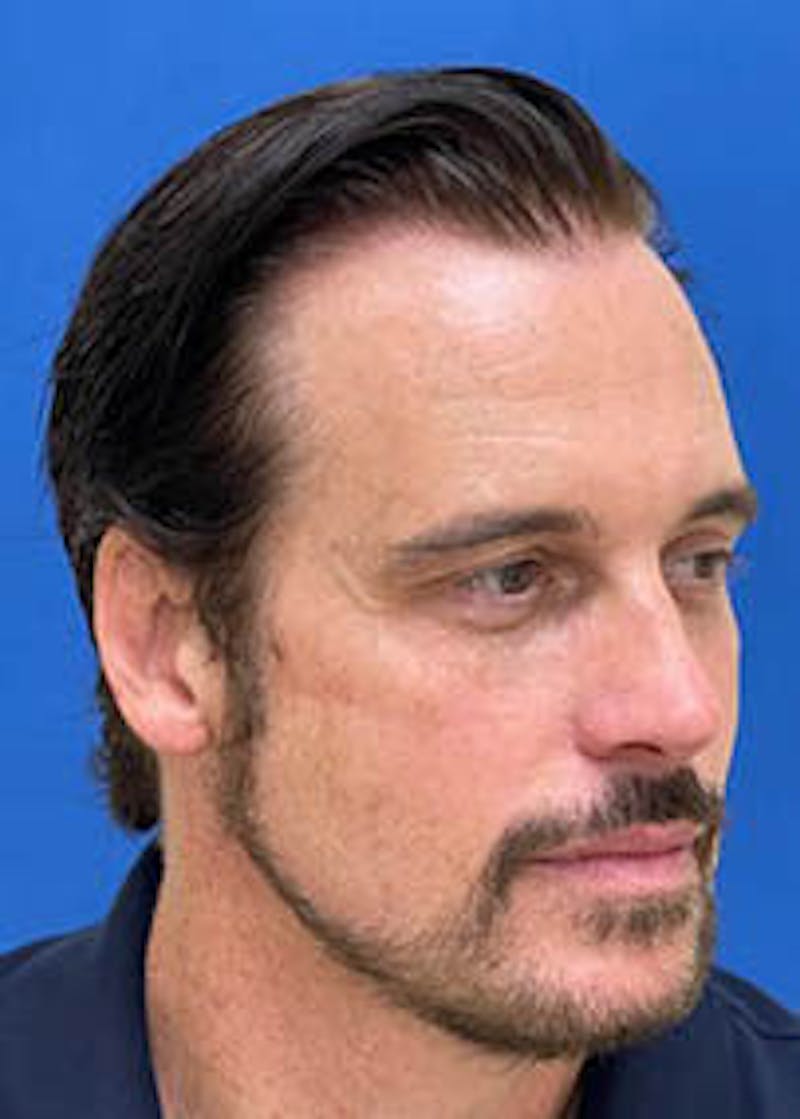Male Surgical Gallery Before & After Gallery - Patient 166658355 - Image 6
