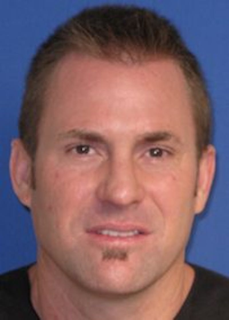 Male Surgical Gallery Before & After Gallery - Patient 166658357 - Image 1