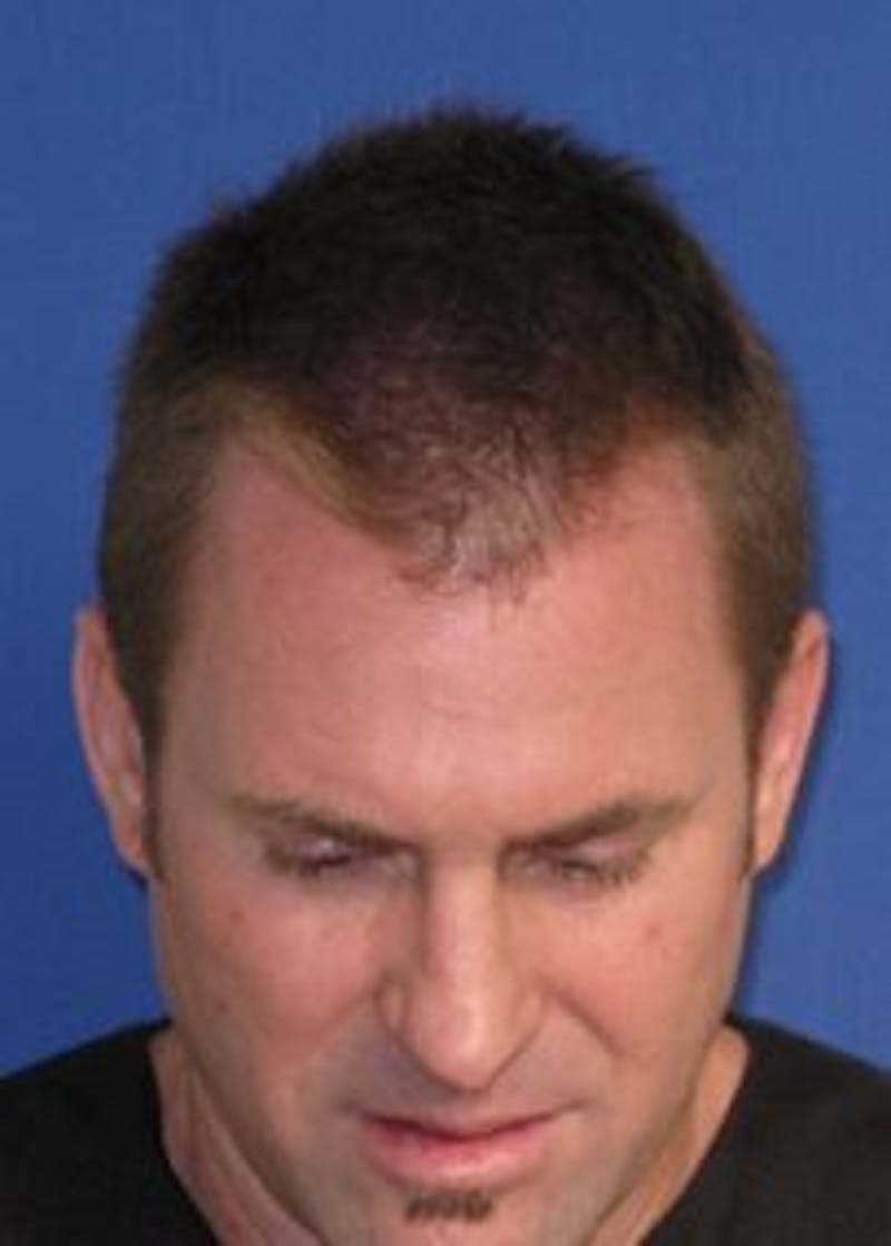 Male Surgical Gallery Before & After Gallery - Patient 166658357 - Image 3