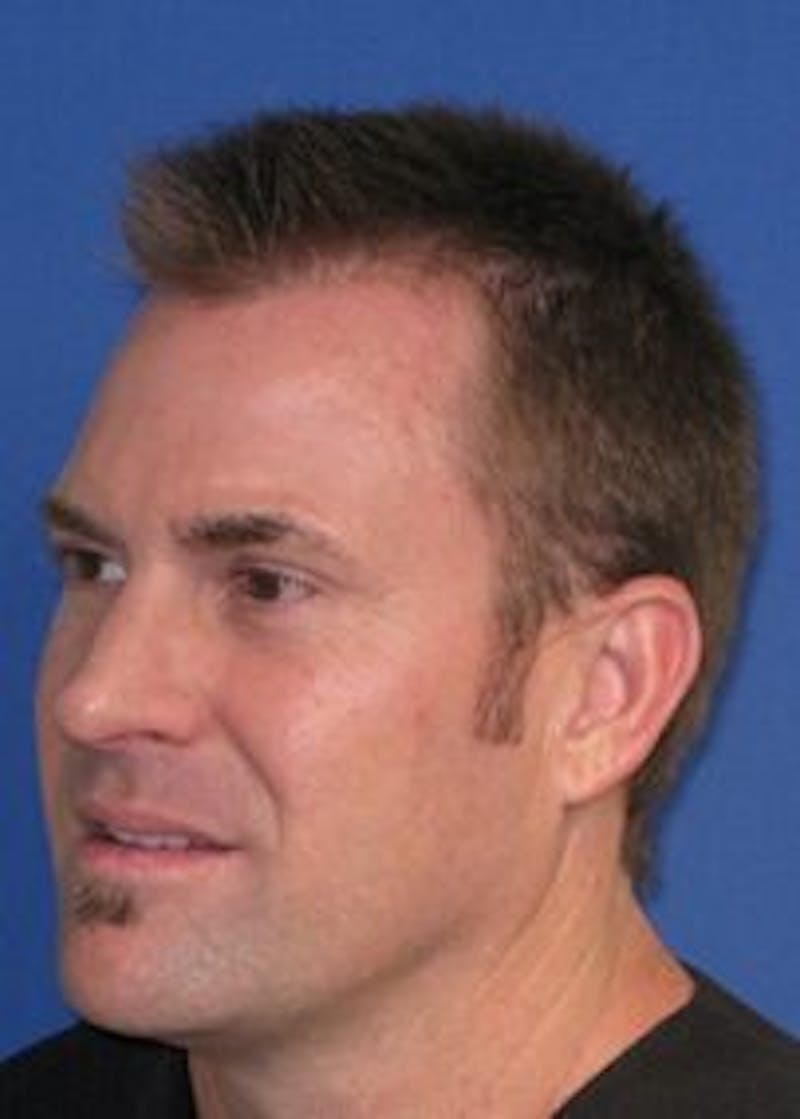 Male Surgical Gallery Before & After Gallery - Patient 166658357 - Image 5