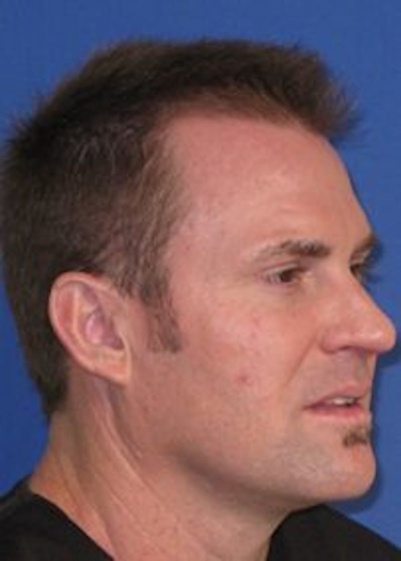 Male Surgical Gallery Before & After Gallery - Patient 166658357 - Image 7