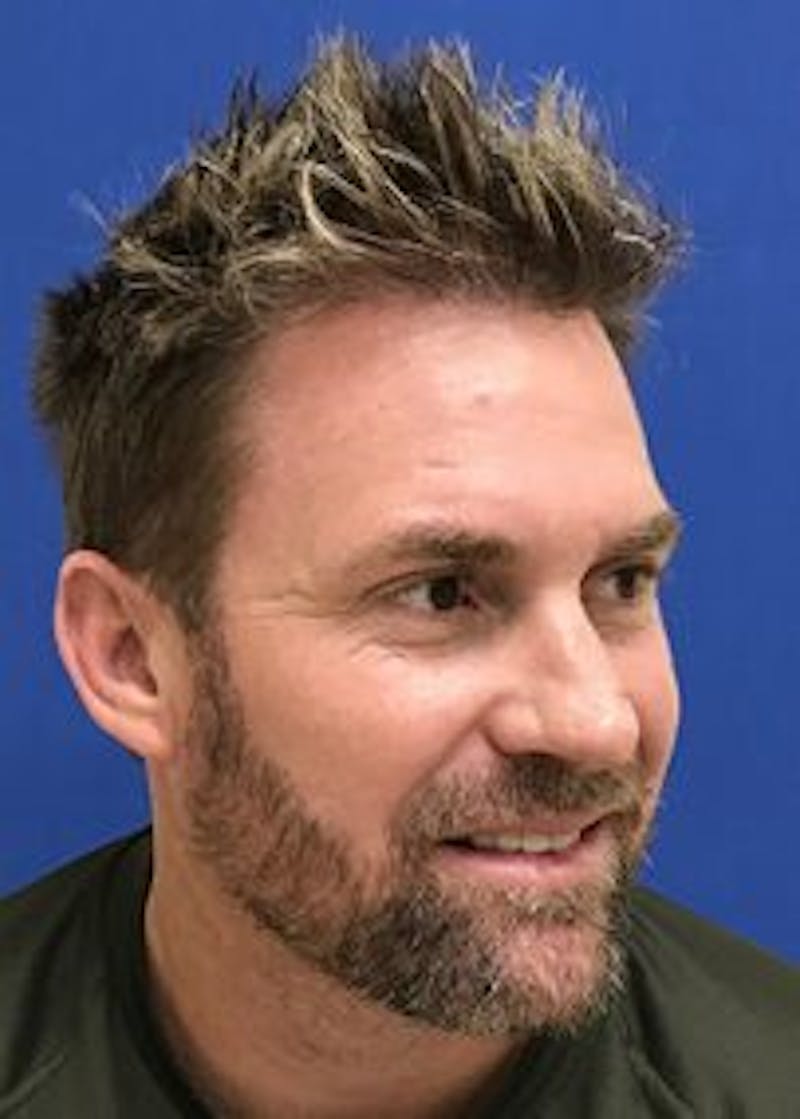 Male Surgical Gallery Before & After Gallery - Patient 166658357 - Image 8