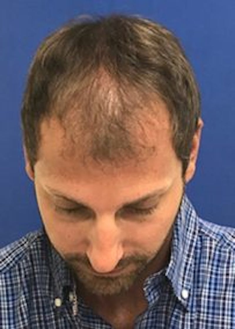 Male Surgical Gallery Before & After Gallery - Patient 166658377 - Image 3