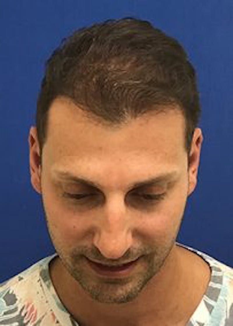 Male Surgical Gallery Before & After Gallery - Patient 166658377 - Image 4
