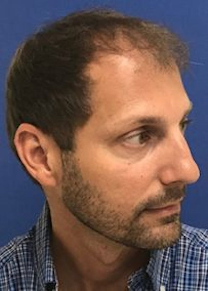 Male Surgical Gallery Before & After Gallery - Patient 166658377 - Image 5