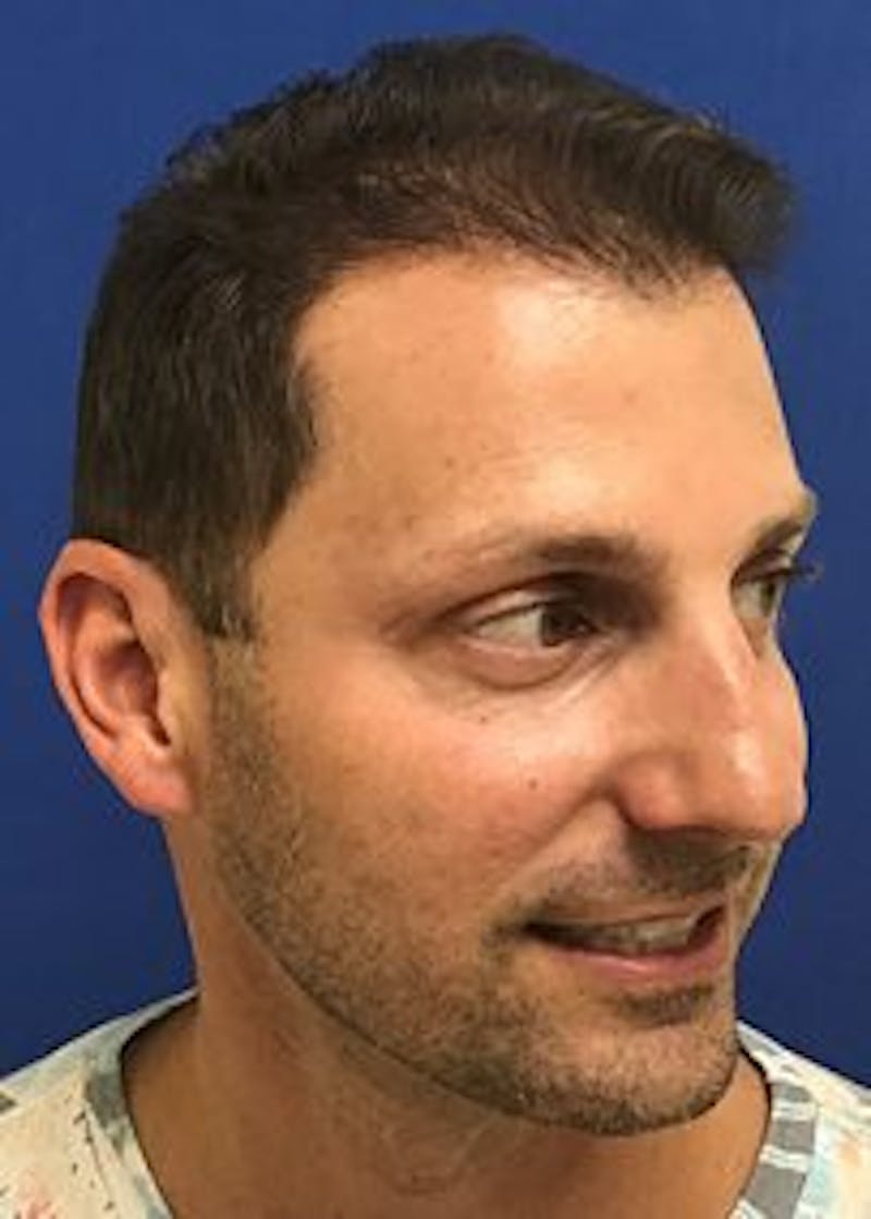 Male Surgical Gallery Before & After Gallery - Patient 166658377 - Image 6