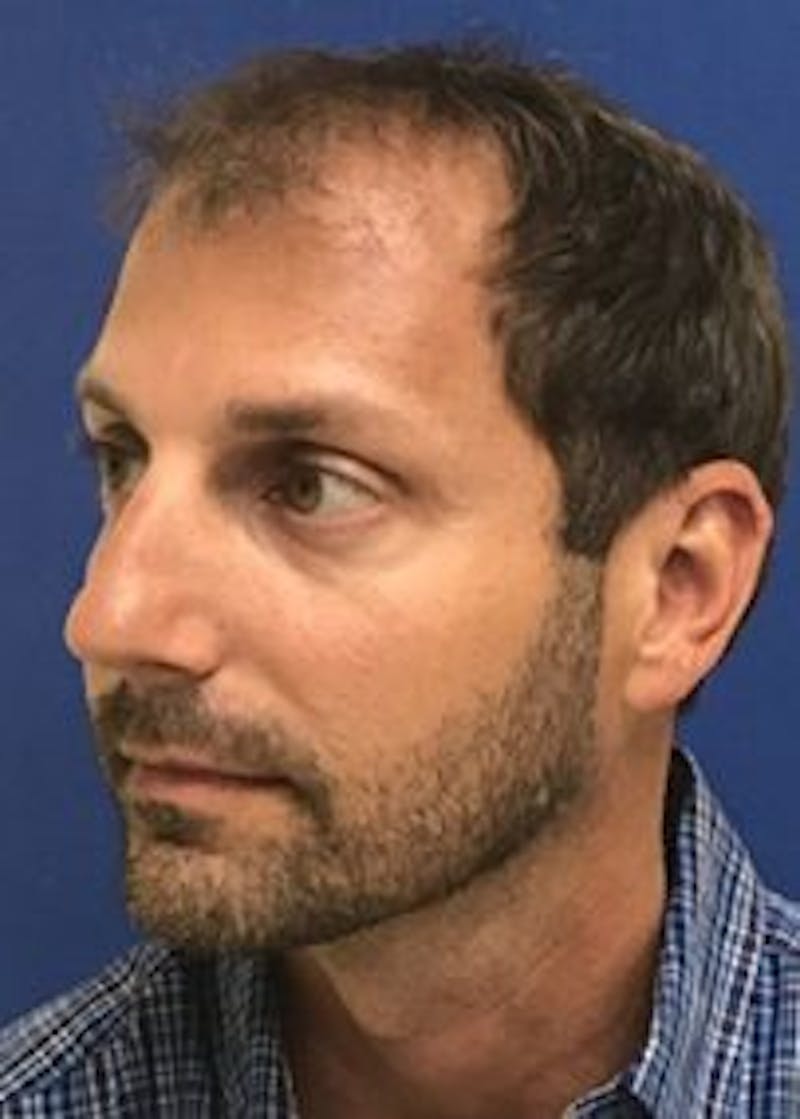 Male Surgical Gallery Before & After Gallery - Patient 166658377 - Image 7